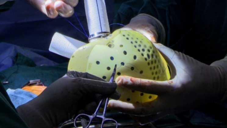 Primer Corazón Totalmente Artificial Trasplantado con Éxito en los Estados Unidos
